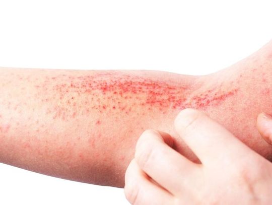 Kosmetyki na atopowe zapalenie skóry z naturalnymi składnikami